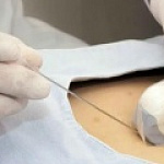 Пункция молочной железы в клинике MED4YOU Пункция молочной железы в клинике MED4YOU