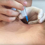 Лечебные блокады