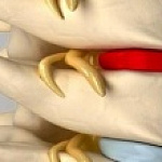 МЕЖПОЗВОНОЧНАЯ ГРЫЖА: КОГДА НЕОБХОДИМО ОБРАЩАТЬСЯ К НЕЙРОХИРУРГУ. МЕЖПОЗВОНОЧНАЯ ГРЫЖА: КОГДА НЕОБХОДИМО ОБРАЩАТЬСЯ К НЕЙРОХИРУРГУ.