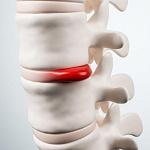 ГЛАВНЫЕ СИМПТОМЫ МЕЖПОЗВОНОЧНОЙ ГРЫЖИ ГЛАВНЫЕ СИМПТОМЫ МЕЖПОЗВОНОЧНОЙ ГРЫЖИ