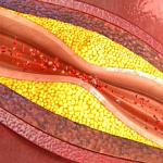 АТЕРОСКЛЕРОТИЧЕСКИЕ (ХОЛЕСТЕРИНОВЫЕ) БЛЯШКИ В СОСУДАХ: КАК ПРОВЕРИТЬ?