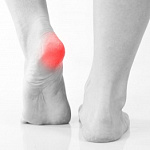 КАК ПРОЯВЛЯЕТСЯ ПЯТОЧНАЯ ШПОРА? КАК ПРОЯВЛЯЕТСЯ ПЯТОЧНАЯ ШПОРА?