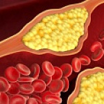 АТЕРОСКЛЕРОТИЧЕСКИЕ (ХОЛЕСТЕРИНОВЫЕ) БЛЯШКИ В СОСУДАХ: КАК ПРОВЕРИТЬ? АТЕРОСКЛЕРОТИЧЕСКИЕ (ХОЛЕСТЕРИНОВЫЕ) БЛЯШКИ В СОСУДАХ: КАК ПРОВЕРИТЬ?
